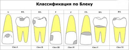 Clasificarea cariilor dentare, a cariilor dentare (fotografii și filme)