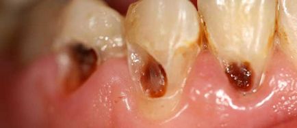 Osztályozása a fogszuvasodás, a fogszuvasodás típusok (fotók és videó)