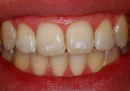 Класифікація карієсу зубів, види карієсу зубів (фото і відео)