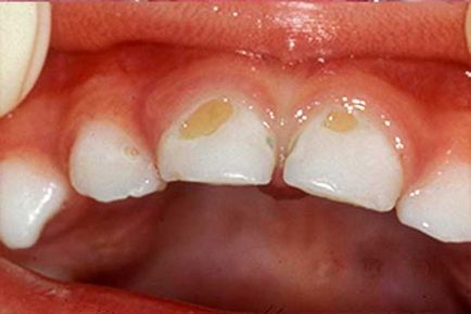 Osztályozása a fogszuvasodás, a fogszuvasodás típusok (fotók és videó)