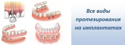 Contacte, implantarea dinților - servicii stomatologice 2002 la Kolomna, stomatologie