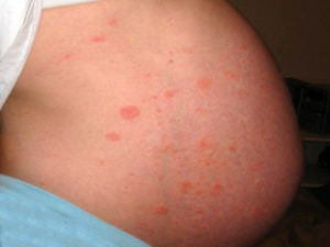 Кропив'янка при вагітності причини, симптоми, методи лікування