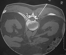 Rm - ellenőrzött fog körüli epidurális - Spine idegsebészet (idegsebészet Idegsebészeti Center Hospital idegsebész vertebrologist Spine centrifugálás gerinc műtét minimálisan invazív endosebészeti CT porckorong sérv műtét tessys lemez nyaki háti gerinc postnichny Medical Center orvosa a kezelés operatív) Rm - ellenőrzött fog körüli epidurális - Idegsebészeti gerinc