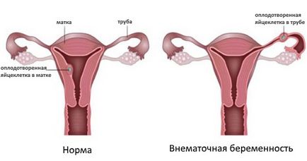 Laparoscopie cu pregătire ectopică de sarcină, intervenție chirurgicală, recuperare