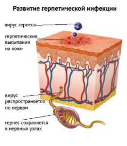 Tratamentul herpesului pe cap