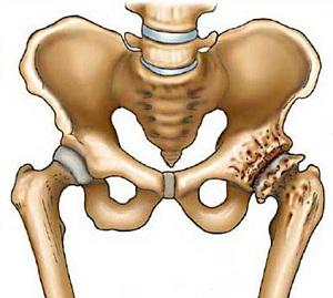 Kezelése coxarthrosis hip dolog tudni betegek, új gyógyszereket kezelésére