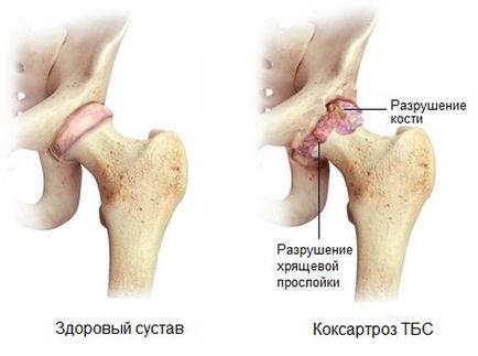 Tratamentul coxartrozei articulației de șold pe care pacienții trebuie să o cunoască, medicamente noi pentru tratament