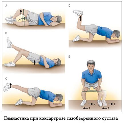 Kezelése coxarthrosis hip dolog tudni betegek, új gyógyszereket kezelésére