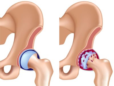 Kezelése coxarthrosis hip dolog tudni betegek, új gyógyszereket kezelésére