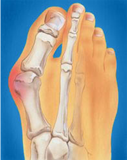Лікування кісточки на пальці, шишки на нозі методом ударно-хвильової терапії