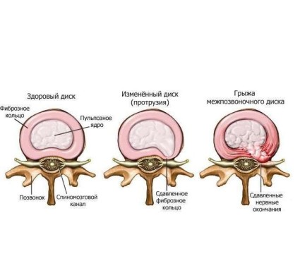 Tratamentul proeminențelor discului spinării coloanei vertebrale lombare, tipuri, metode