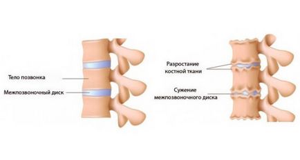 Tratamentul osteocondrozei cervicale