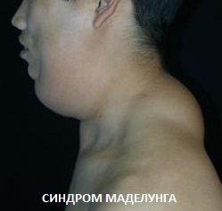 Ліпома (жировик) на шиї синдром Маделунга і ін
