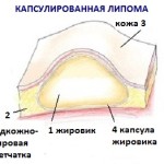 Ліпома (жировик) на шиї синдром Маделунга і ін