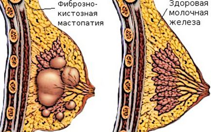 Mastopatia - simptome, tipuri și tratament al bolilor mamare, remedii folclorice