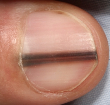Меланома нігтя піднігтьового, які ознаки, як розпізнати і визначити, діагностика, лікування