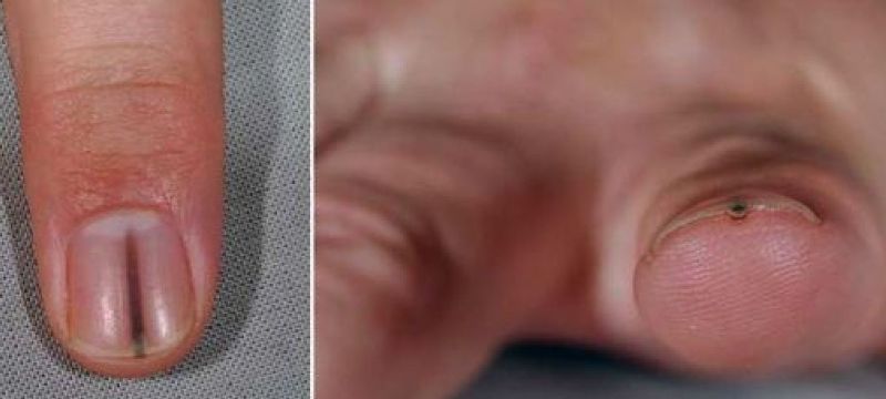 Меланома нігтя піднігтьового, які ознаки, як розпізнати і визначити, діагностика, лікування