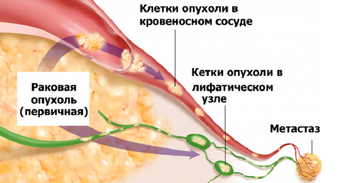 Метастази в легенях симптоми, ознаки та як вилікувати