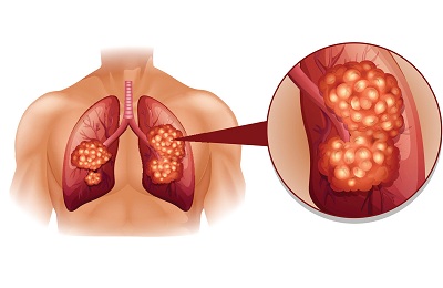 Метастази в легенях симптоми, ознаки та як вилікувати