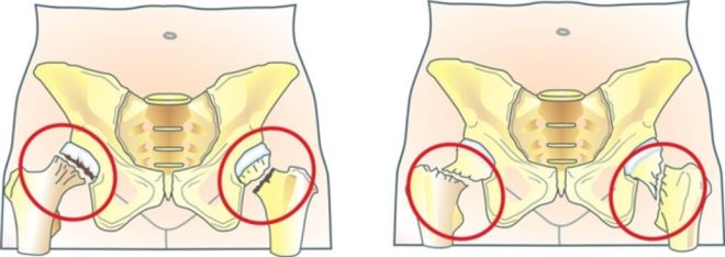 Народні засоби при переломі шийки стегна