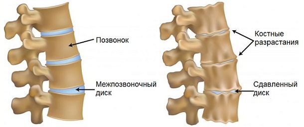 Dispnee cu osteochondroză este un simptom al patologiei coloanei vertebrale toracice