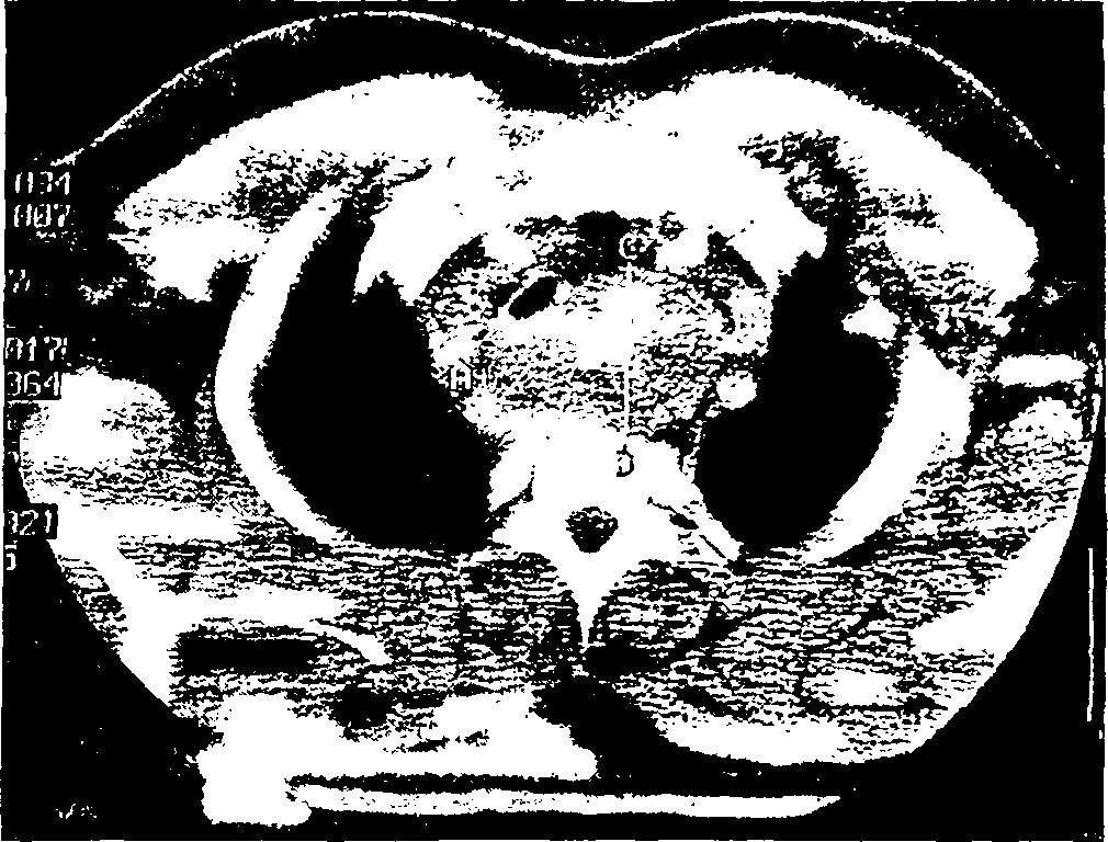 Tumori și chisturi ale mediastinului