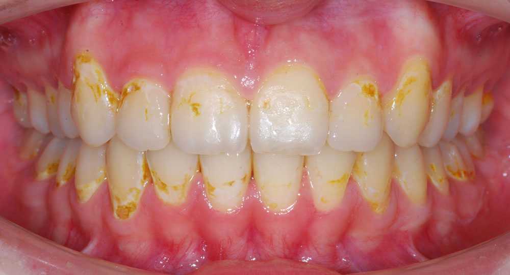 Complicațiile tratamentului ortodontic
