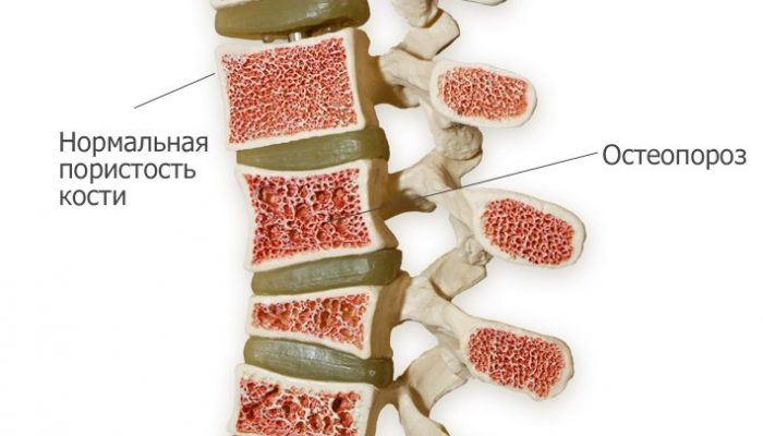 Остеопороз хребта симптоми і лікування