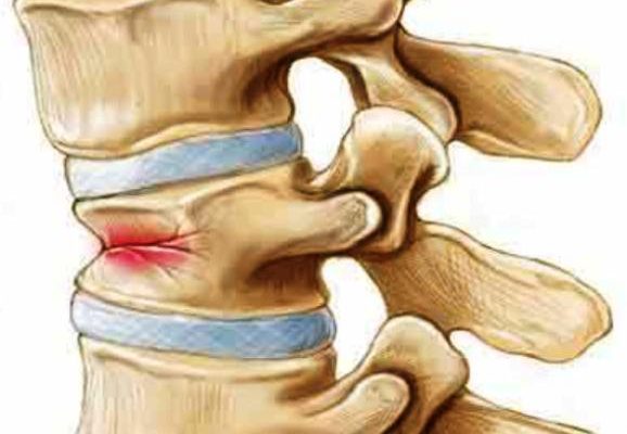 Osteoporoza simptomelor și tratamentului coloanei vertebrale