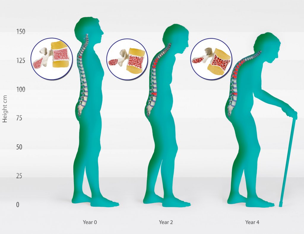 Osteoporoza simptomelor și tratamentului coloanei vertebrale