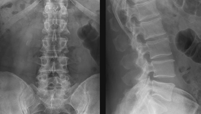 Osteoporoza simptomelor și tratamentului coloanei vertebrale