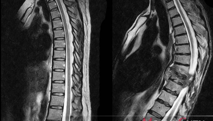 Osteoporoza simptomelor și tratamentului coloanei vertebrale