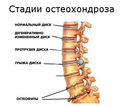 Osteocondrosis de caracteristici de gradul 2, tratament și mecanism de dezvoltare