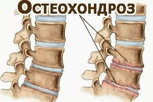 Osteochondrosis 2 fok nyaki, háti és ágyéki