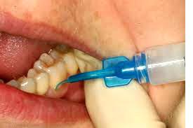 Ozonoterapie pentru dinți, tratament dentar cu terapie cu ozon în Moscova, stomatologie 