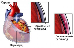 Перикардит - лікування перикардиту народними засобами і методами