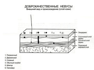 Пігментні родимки і їх особливості