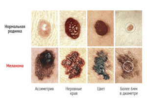 Anyajegyein és azok jellemzői (vegyület epidermisz dermisz) Pigmentált anyajegyek és azok jellemzői