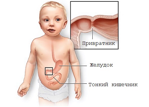 Пілороспазм і пилоростеноз у дітей що потрібно знати батькам про цю патологію, малюк здоровий!