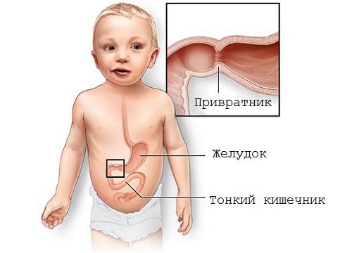 Pylorospasmul și stenoza pilorică la copiii pe care părinții trebuie să știe despre această patologie, copilul este sănătos!