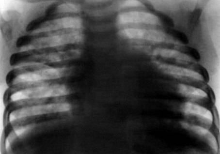 Diagnosticarea, tratamentul, complicațiile pneumocistostului