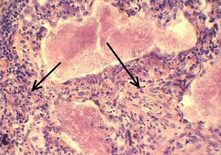 Diagnosticarea, tratamentul, complicațiile pneumocistostului