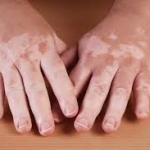 De ce dermalight tratează psoriazisul și vitiligo