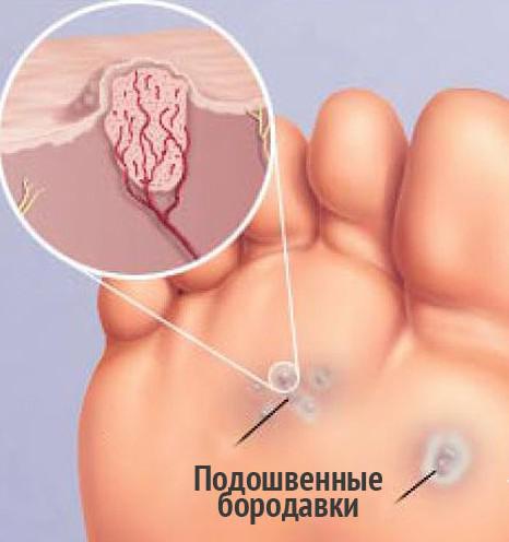Подошвенная бородавка лікування в домашніх умовах, як вилікувати