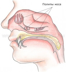 Поліпи в носі симптоми, лікування народними засобами