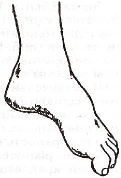 Gait a stroke után - a kezelés a szív (betegségek, az idegrendszer) Gait stroke után - kezelés a szív