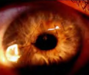 Rănile penetrante ale globului ocular, tratament