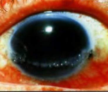 Rănile penetrante ale globului ocular, tratament