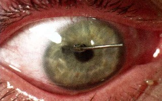 Leziuni penetrante ale globului ocular - prim ajutor și consecințe, tratament la Moscova