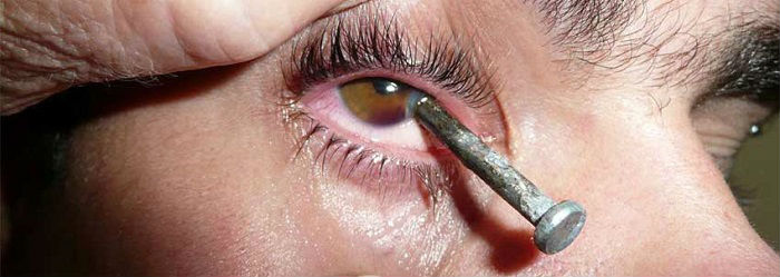 Проникаючі поранення очного яблука - перша допомога і наслідки, лікування в москві